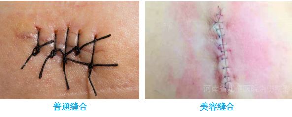 和传统缝合相比,美容缝合是应用专用的美容针,美容线,采用整形美容