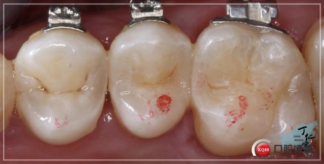 右上后牙二类洞树脂直接修复一例