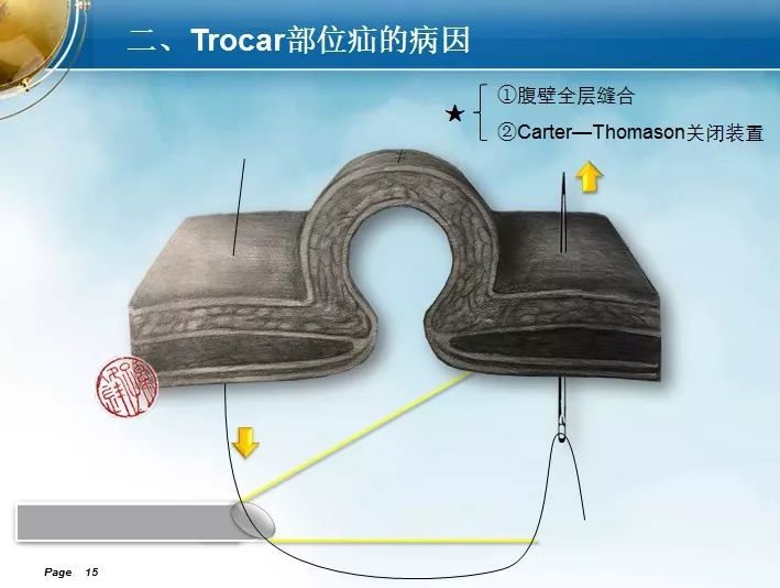 会场速递|腹腔镜trocar部位疝的诊治与预防