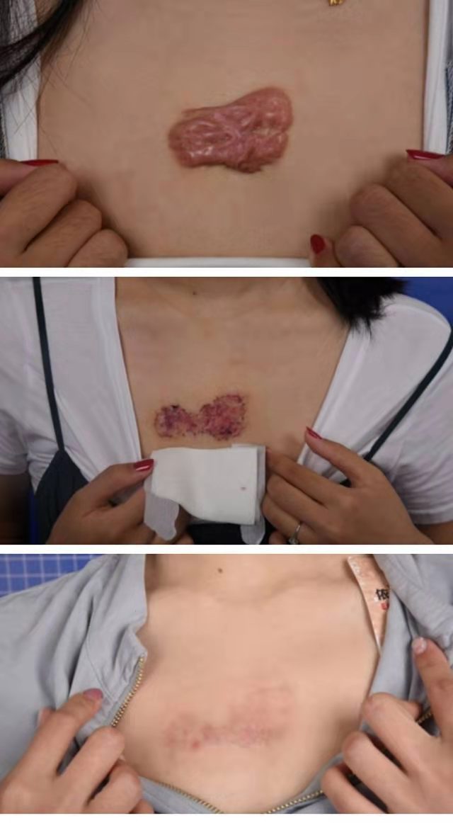 乳腺增生手术疤痕图片