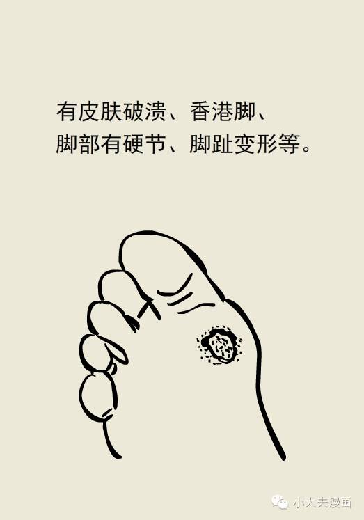 专家糖尿病足一定要重视严重的会截肢