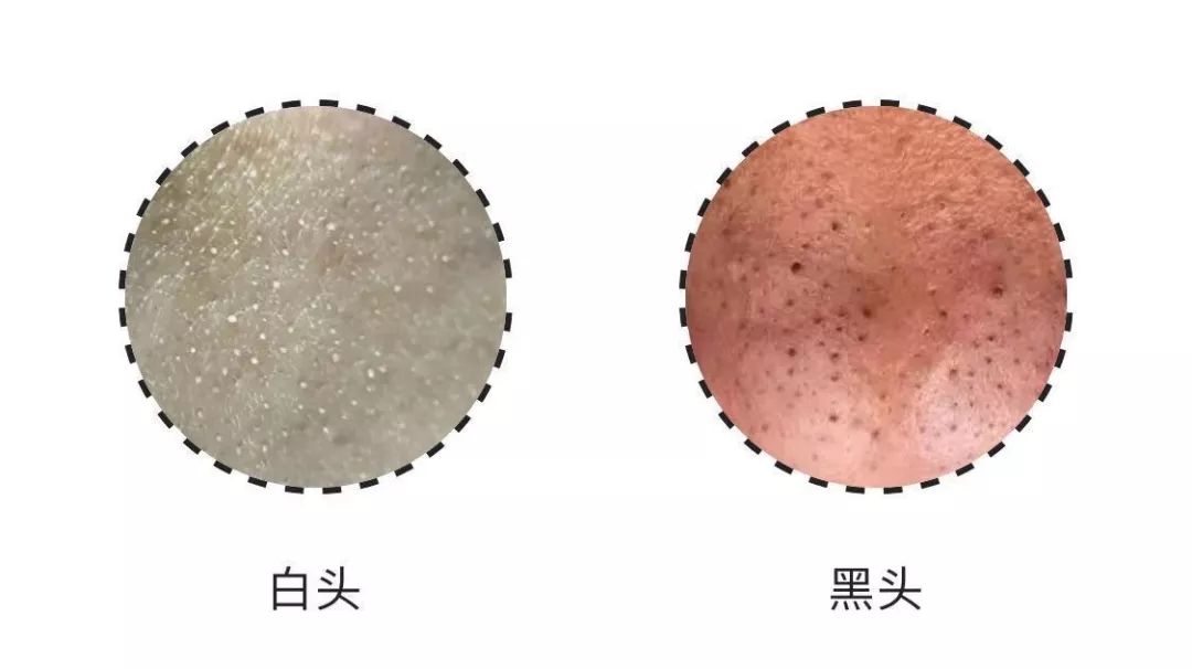 被再用这些方式去闭口啦!真的会烂脸!_粉刺
