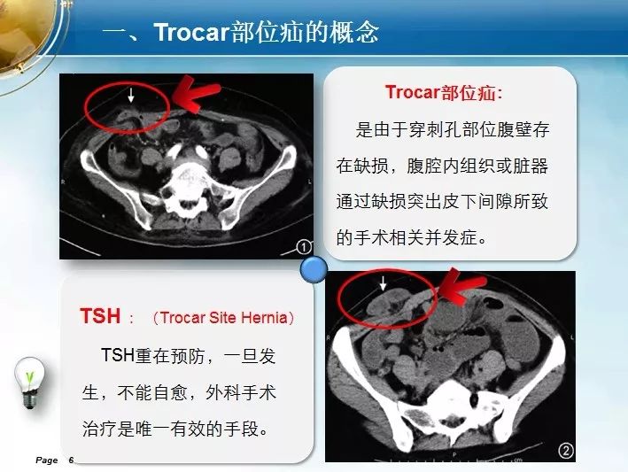 trocar孔图片