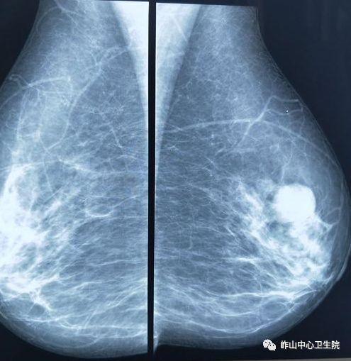 肿块无所遁行 据肿瘤年报显示,我国乳腺癌发病率仍位居女性恶性肿瘤的