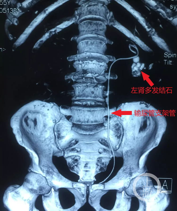 25釐米長導管在男子輸尿管呆了一年多創新體位手術節約數萬元