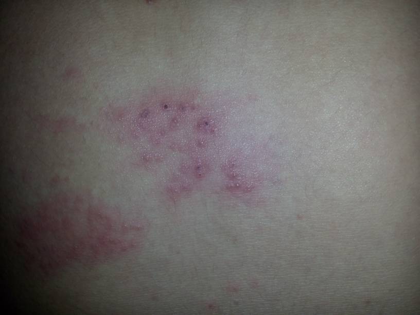 这也是感染艾滋病的最早期症状之一,由于这种皮疹不会感觉到瘙痒,所以