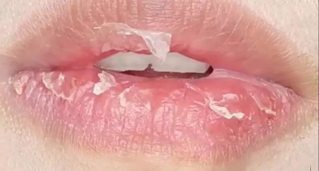 冬天嘴唇开裂起皮让你丑10倍用这三个方法胜过5次唇膜