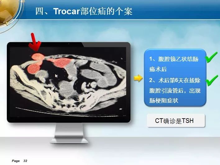 会场速递|腹腔镜trocar部位疝的诊治与预防