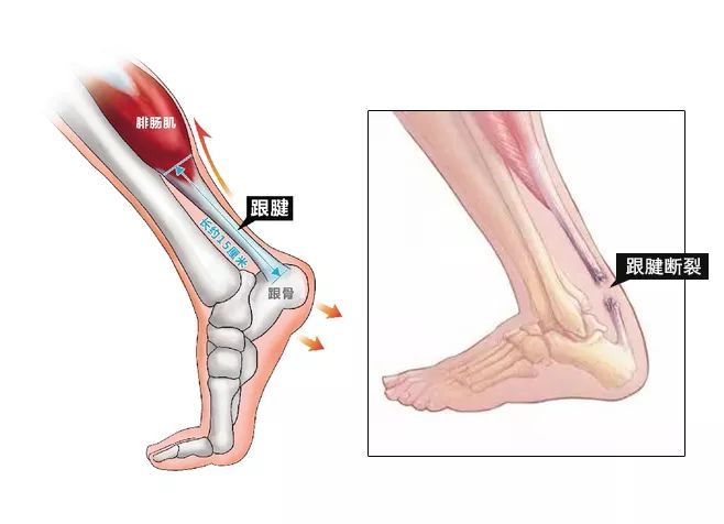 实录 跟腱断裂 就像一场噩梦 我是如何 历劫重生 的 康复