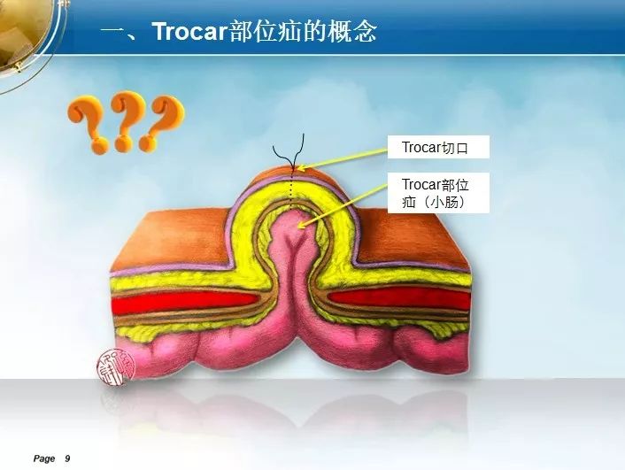 trocar孔图片