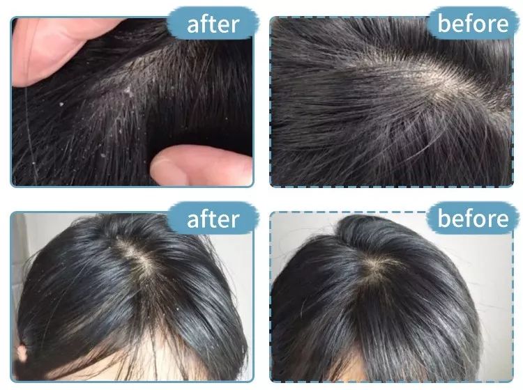 不洗头还能照常约会?变态去油去屑专利,用它,三天不用洗头