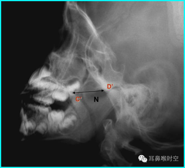 腺样体肥大x光片图片图片