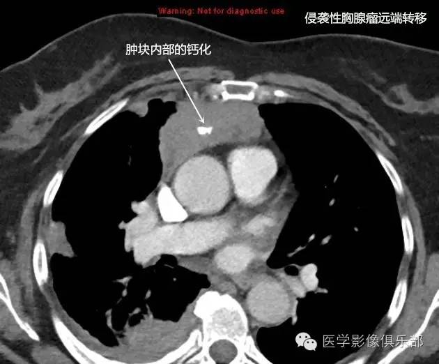 胸腺瘤基础影像