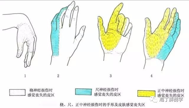 尺神经半脱位图片