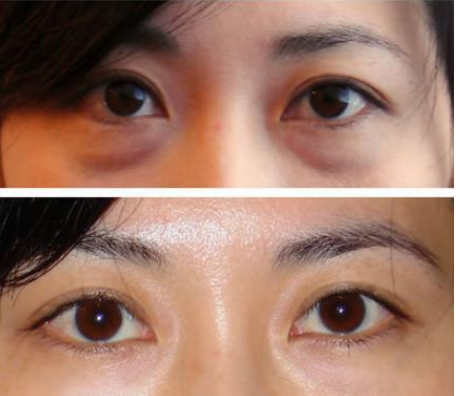 内路去眼袋后遗症有哪些去眼袋术后有哪些注意事项