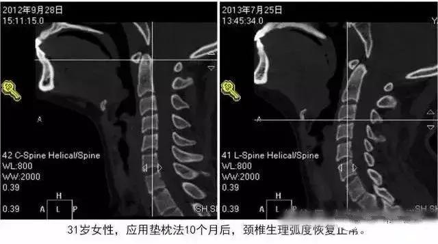 颈椎生理弧度变直或反弓了就不能恢复正常了吗?_治疗