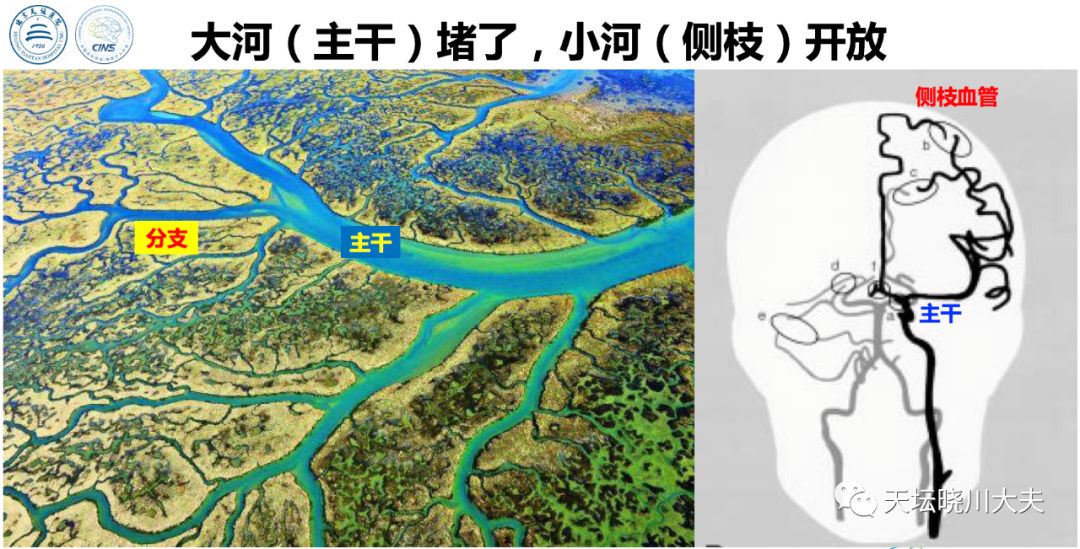 血管闭塞开通——mo.ma内wire trapping技术