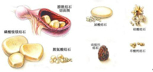 膀胱結石的種類及原因