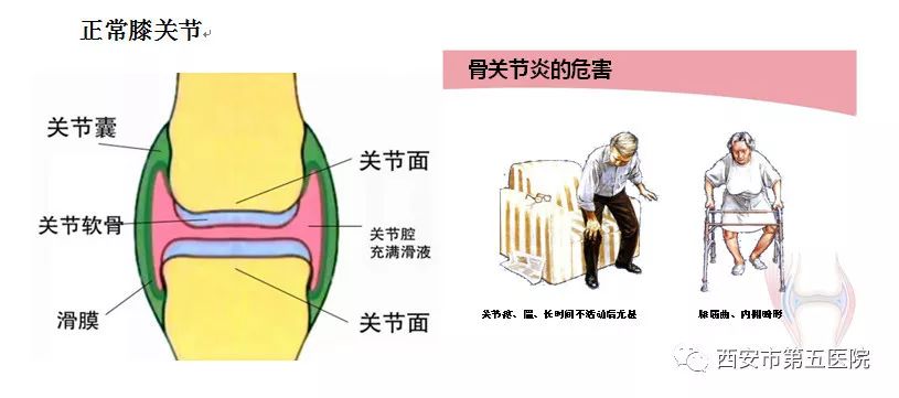 骨关节炎诊断与治疗