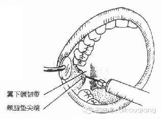 圖5～2 上頜結節注射上牙