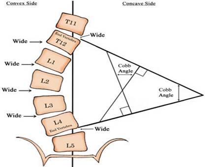脊柱侧弯是怎么发生的平时错误的认为有哪些