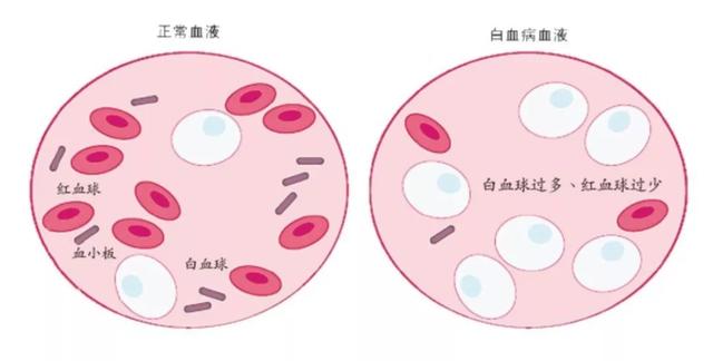 白血病不是血液变白,而是造血组织中恶性白细胞分化异常,通常表现为