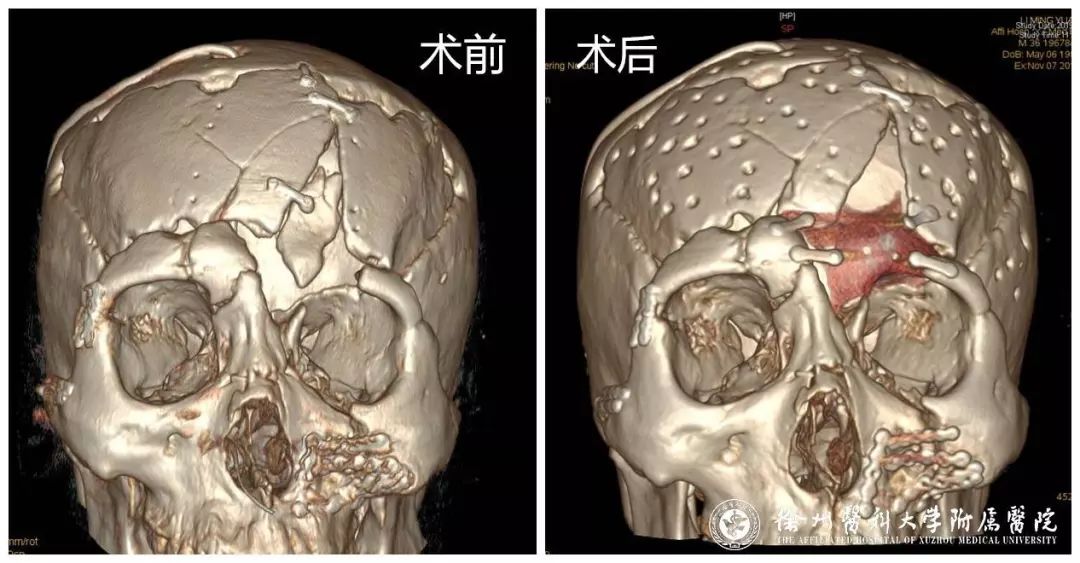 患者:慘遭車禍導致頭面部畸形 醫院:複雜整復促身心全面健康