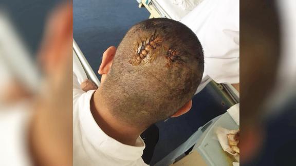 ktv里为争点一首歌两帮男子大打出手头被打破缝了二十多针