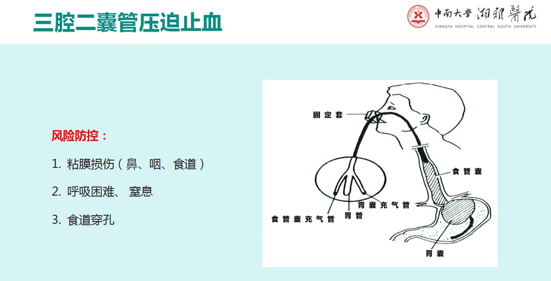 三腔二囊管压迫止血粉丝福利转发本篇文章并下方留言(今晚20点截止)