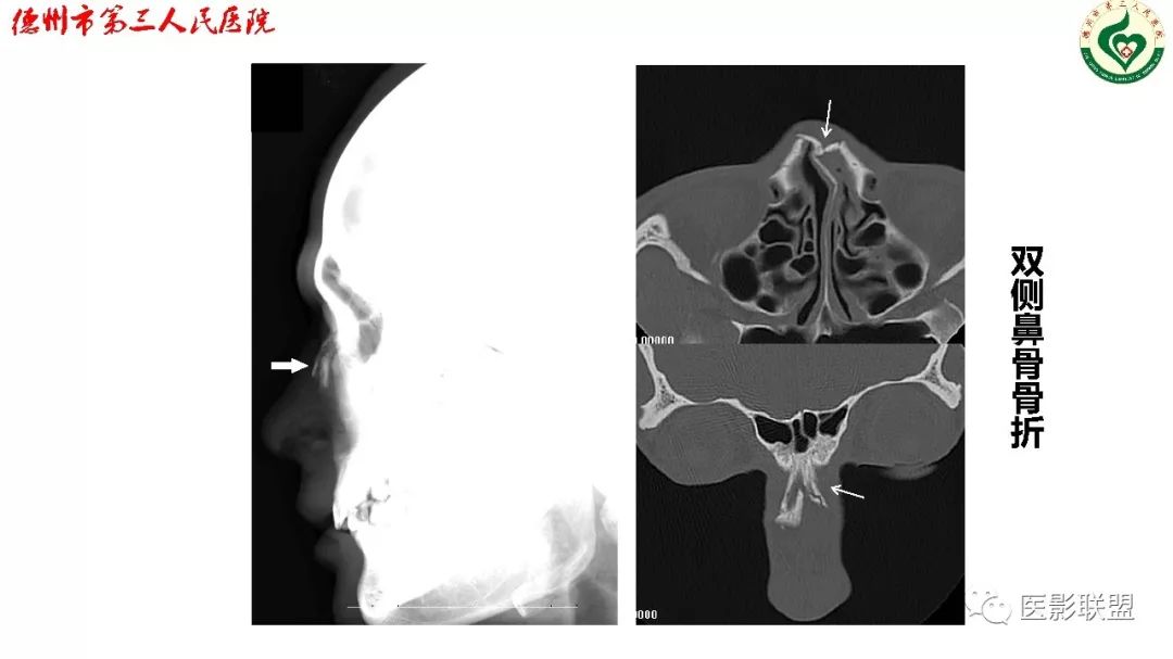 鼻骨X线解剖图片