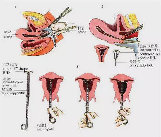 女性取环手术全过程图片