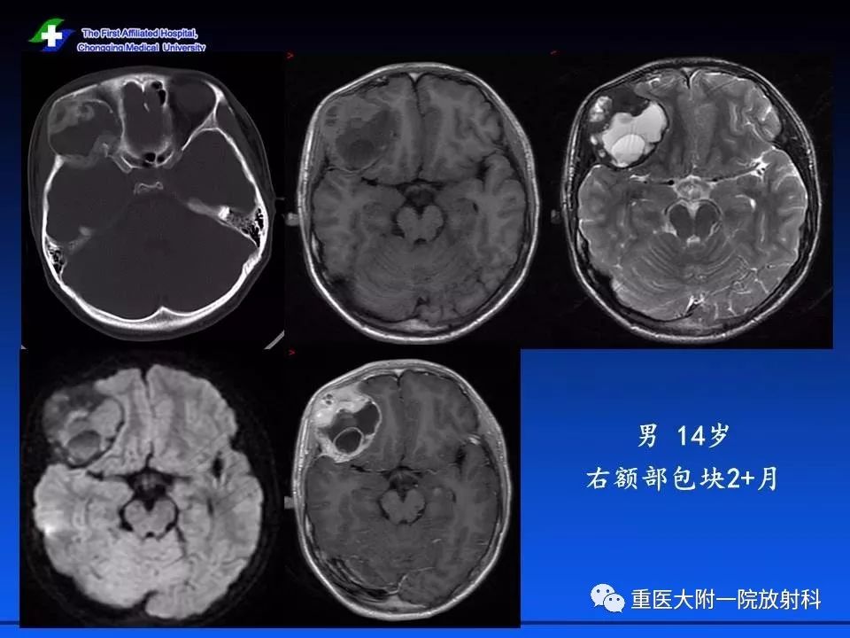 蝶骨骨纤维异常增殖症图片