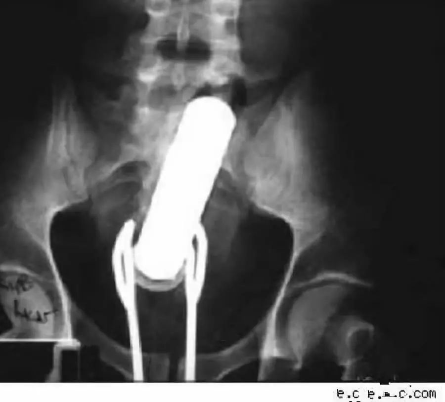 肛肠和泌尿科的x光片藏着成年人最深的秘密