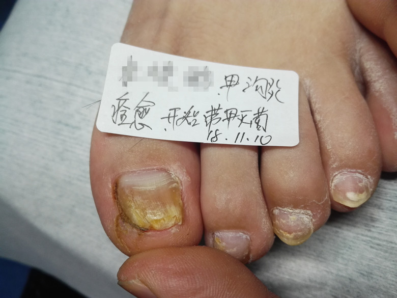 灰指甲克星@衡水哪里治灰指甲?@灰指甲怎么治才能好?