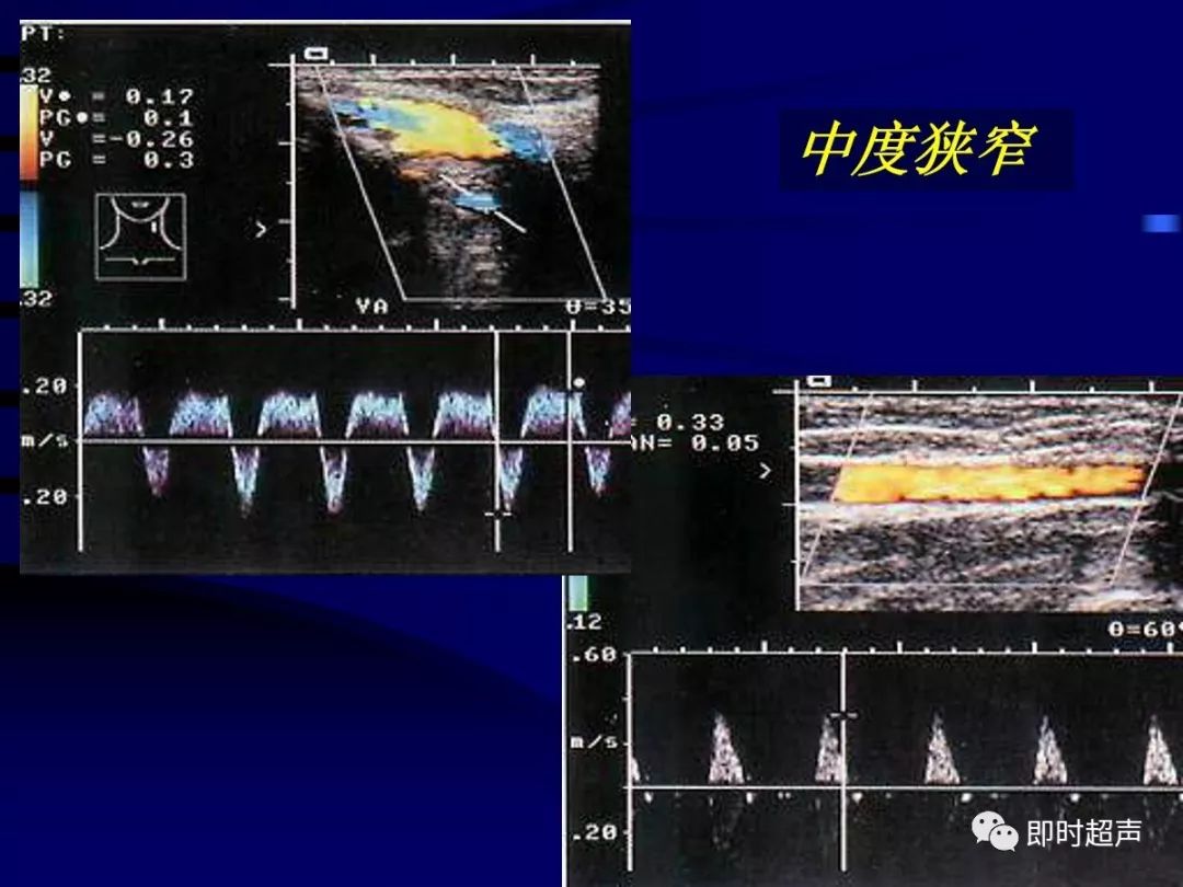 瘘口近心段动脉阻力变小远心段动脉频谱变化不大●静脉管径扩张●瘘口