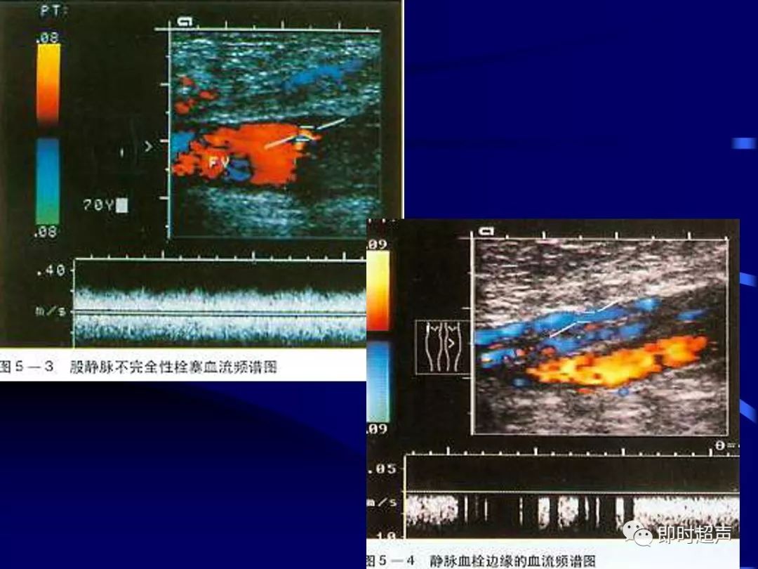 周圍血管疾病多普勒超聲檢查