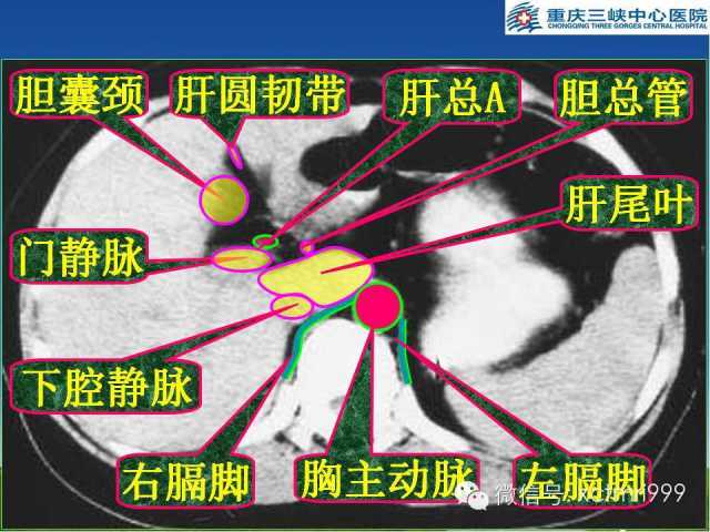 肝脏影像解剖精彩图解肝分叶分段