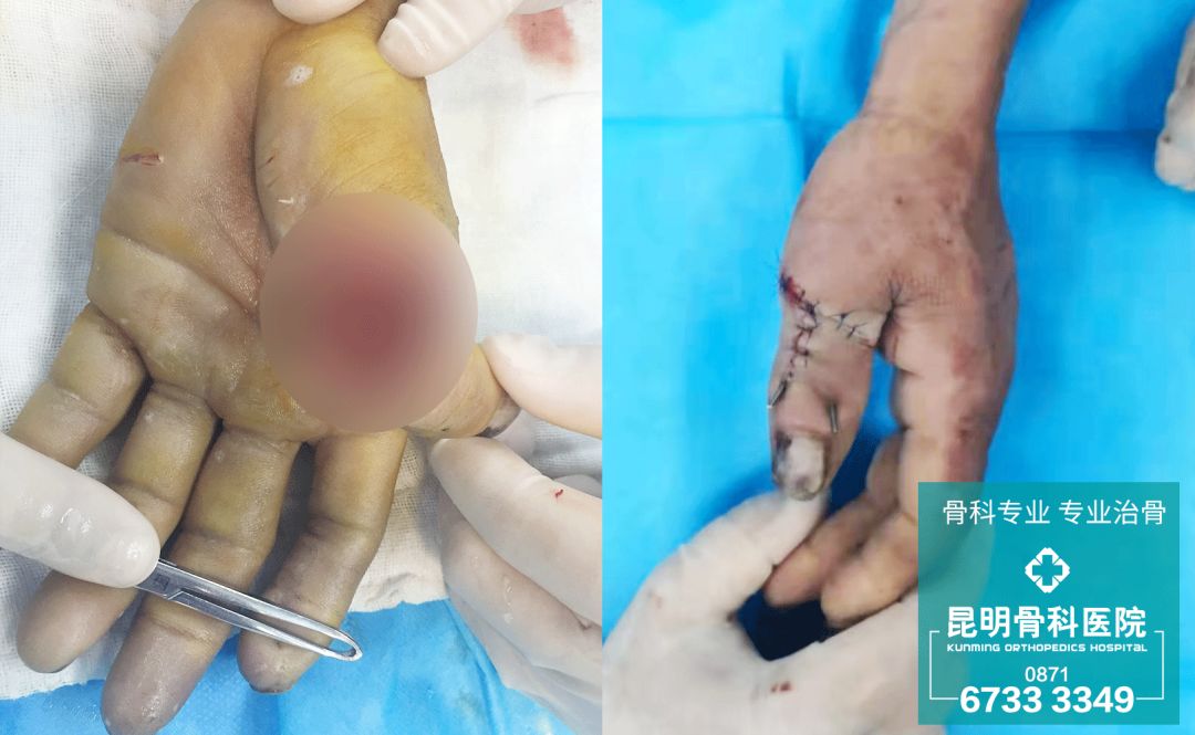 两男子遭遇电锯断指昆骨专家接指成功