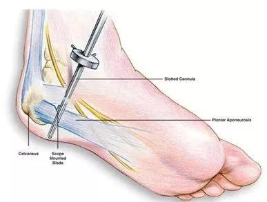 医生提醒脚跟痛别耽误当心是足底筋膜炎