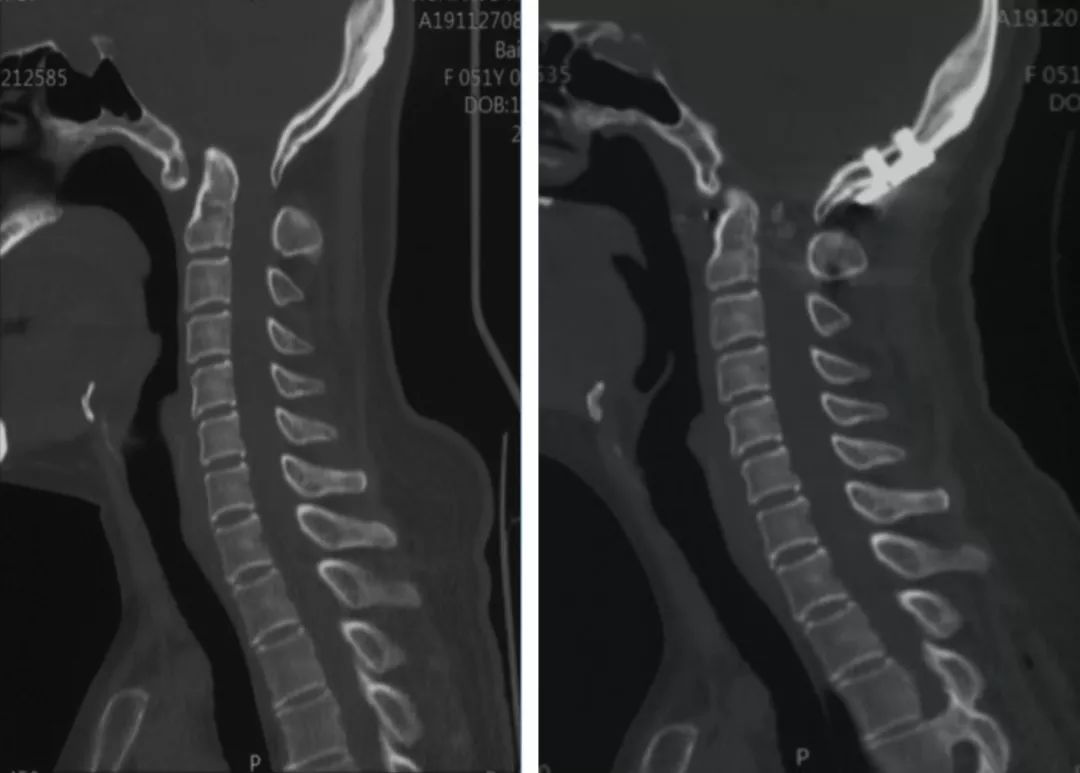 图9-19 颈胸膜外入路的手术体位-脊柱手术技术-医学