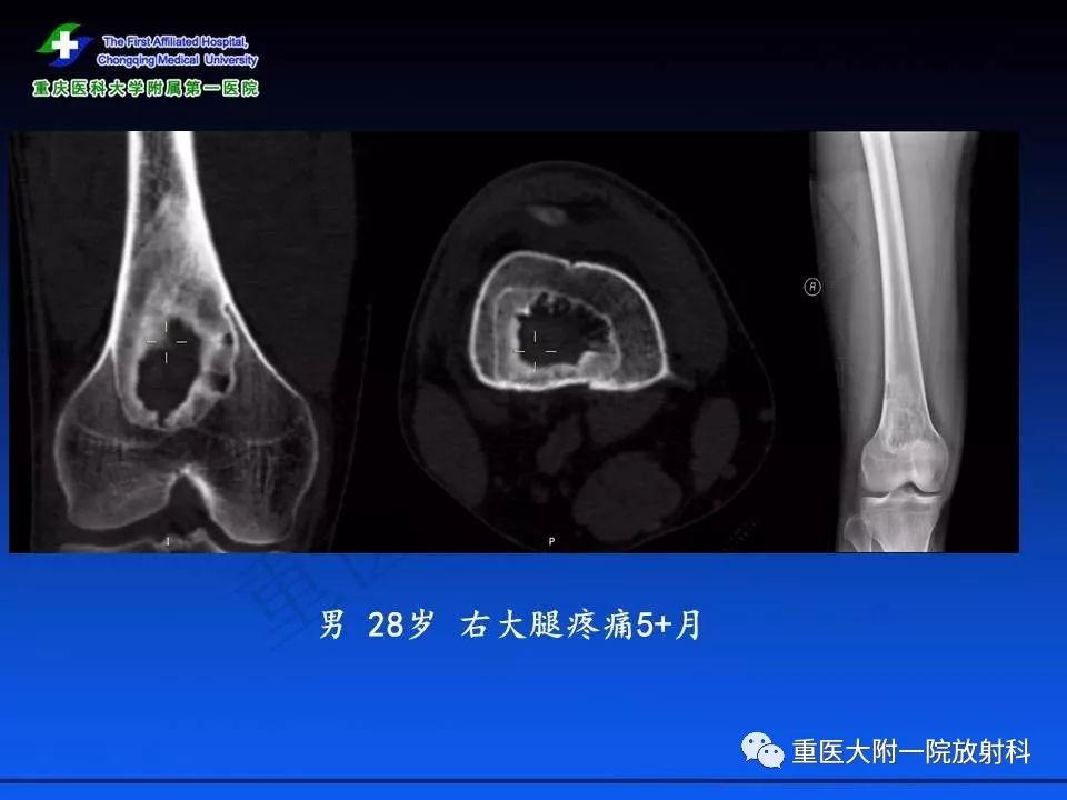 骨纤维结构不良骨纤维异常增殖症影像表现
