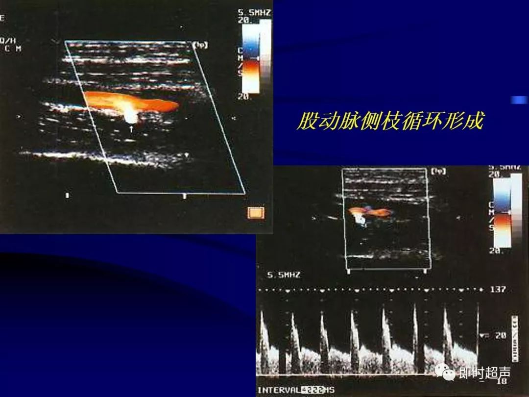周圍血管疾病多普勒超聲檢查