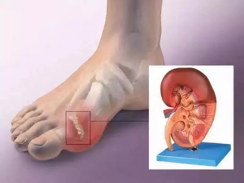 把肾养好才能从根本上驱除痛风