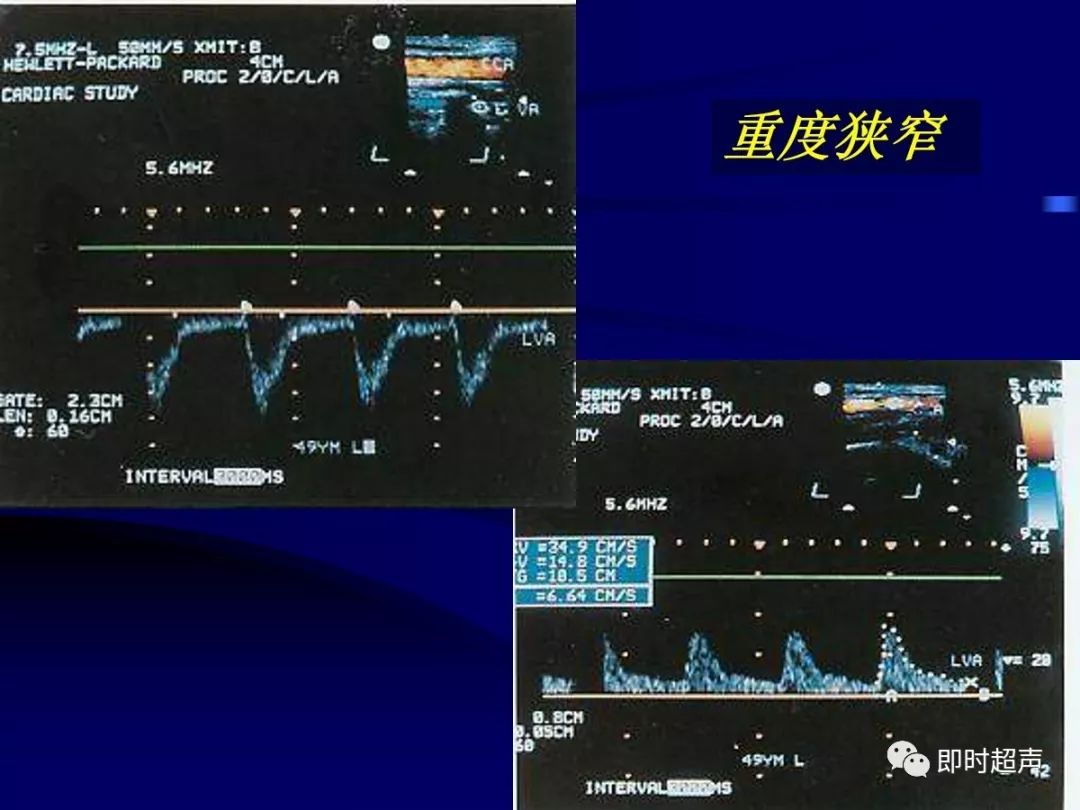 瘘口近心段动脉阻力变小远心段动脉频谱变化不大●静脉管径扩张●瘘口