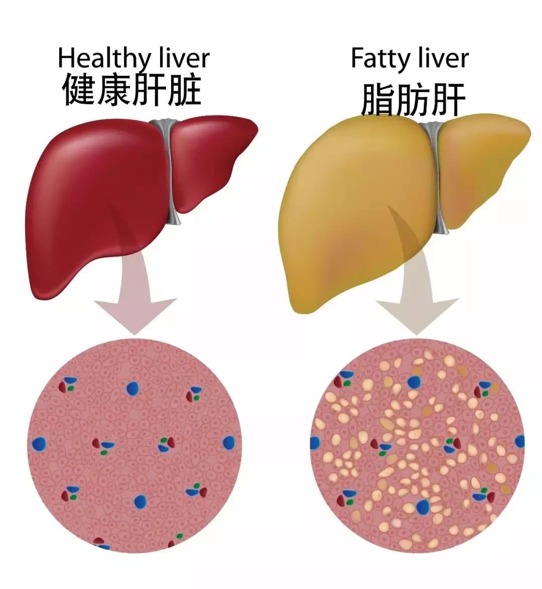 正常肝内脂肪占肝重3—4,若肝内脂肪含量超过5%即为轻度脂肪肝,超过