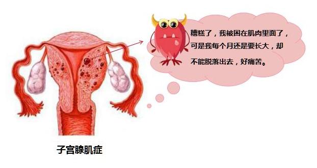 子宫腺肌症早期症状图片