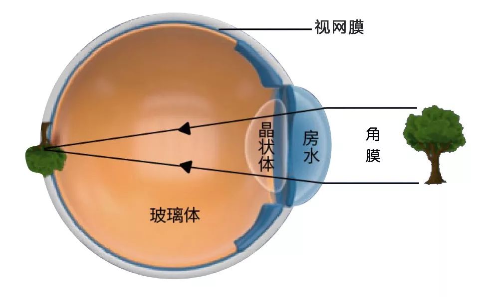 近视眼视网膜成像图图片