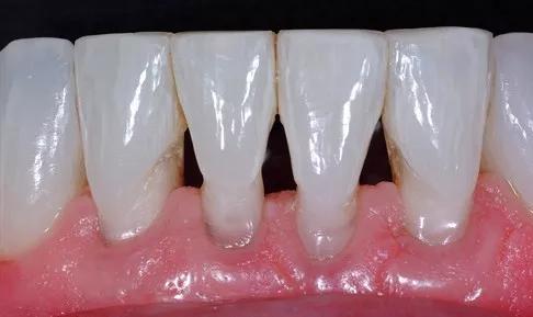 当牙龈不能完全覆盖两个牙齿的牙颈部与接触点之间的间隙时,在两颗