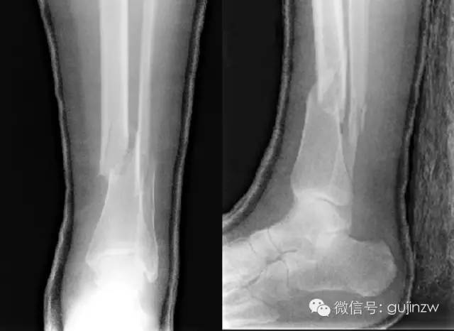 fracture▼蹠骨骨折▼正常骨盆正位片▼常見髖關節測定線▼骨盆骨折▼