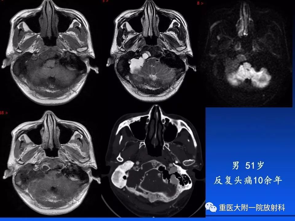 蝶骨骨纤维异常增殖症图片